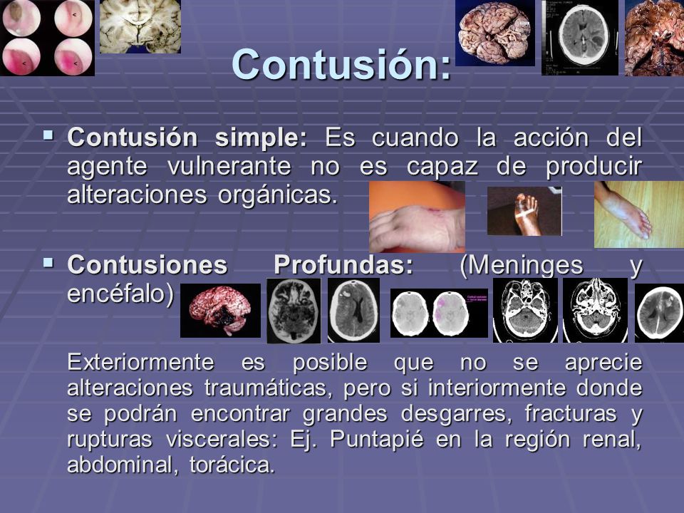 Contusión: Contusión simple: Es cuando la acción del agente vulnerante no es capaz de producir alteraciones orgánicas.