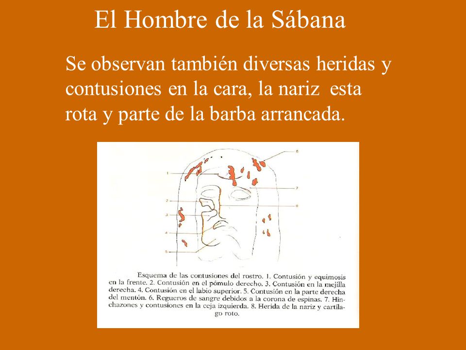 El Hombre de la Sábana Se observan también diversas heridas y contusiones en la cara, la nariz esta rota y parte de la barba arrancada.