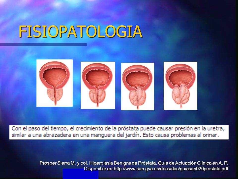 hiperplasia benigna de prostata fisiopatologia pdf)