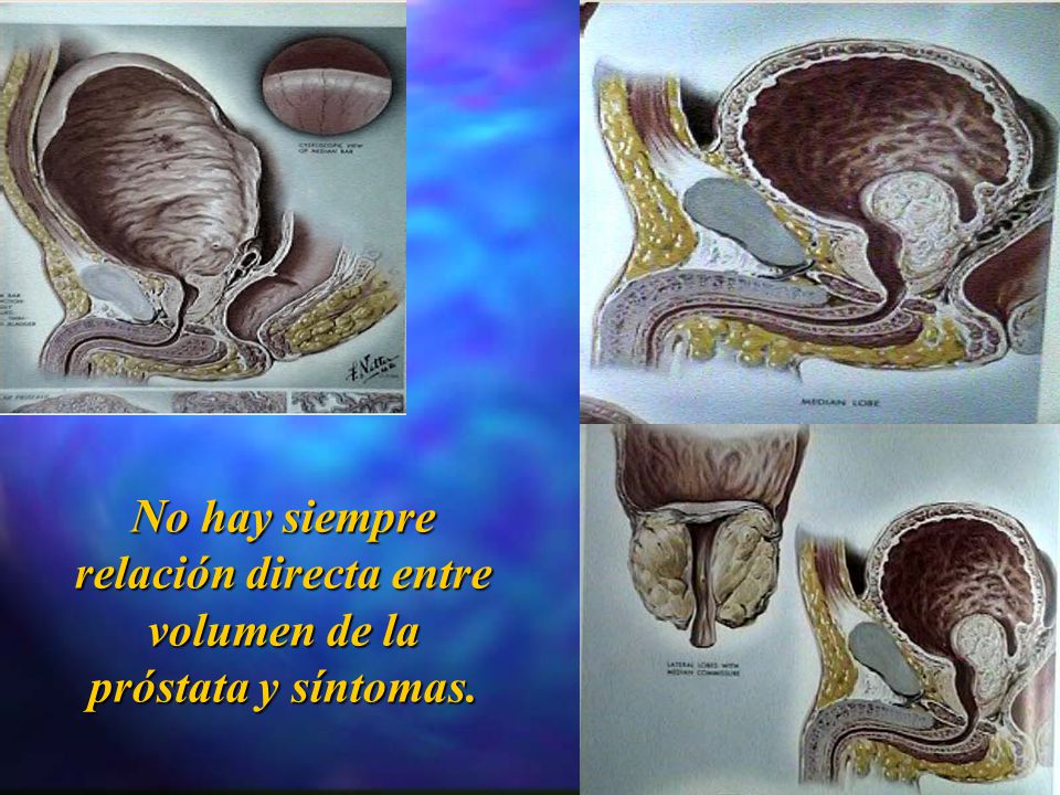 No hay siempre relación directa entre volumen de la próstata y síntomas.