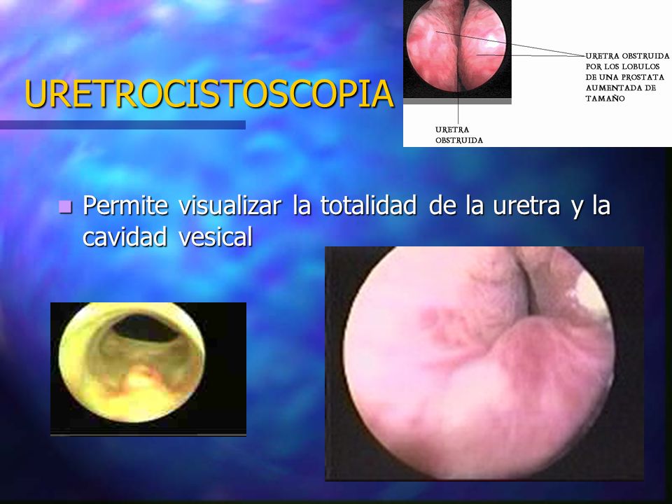 URETROCISTOSCOPIA Permite visualizar la totalidad de la uretra y la cavidad vesical