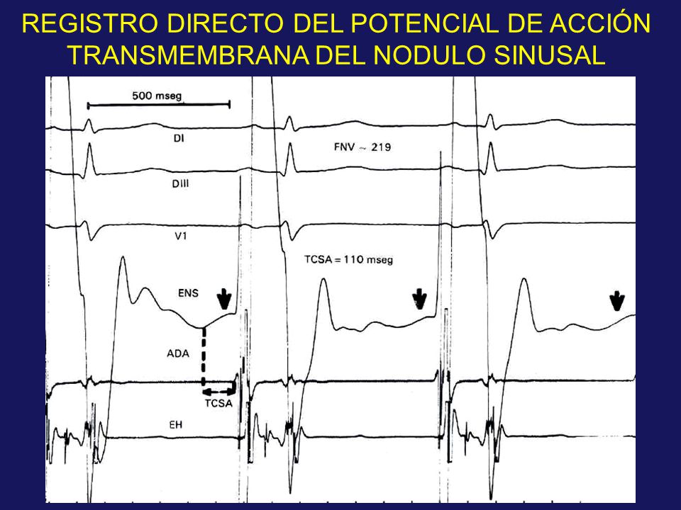 REGISTRO DIRECTO DEL POTENCIAL DE ACCIÓN TRANSMEMBRANA DEL NODULO SINUSAL