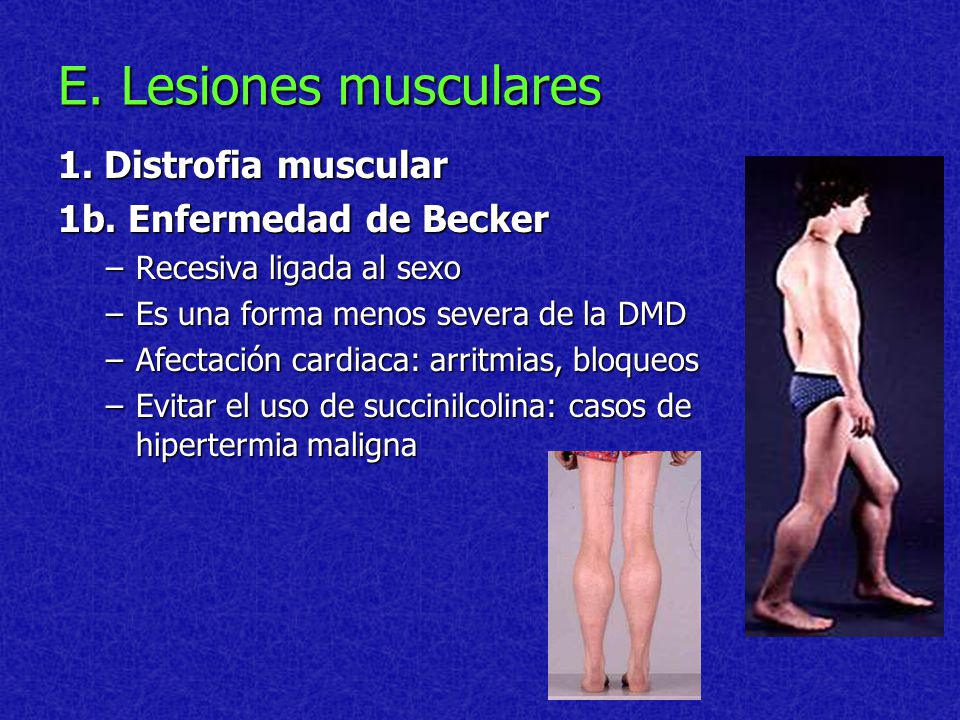 E. Lesiones musculares 1. Distrofia muscular 1b. Enfermedad de Becker