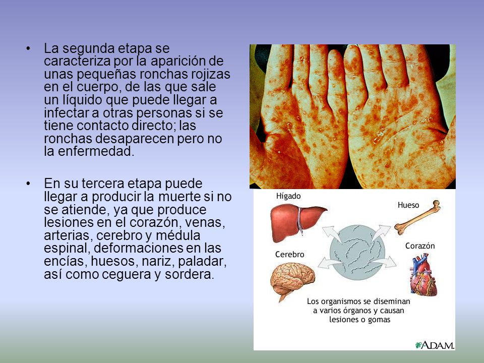 La segunda etapa se caracteriza por la aparición de unas pequeñas ronchas rojizas en el cuerpo, de las que sale un líquido que puede llegar a infectar a otras personas si se tiene contacto directo; las ronchas desaparecen pero no la enfermedad.