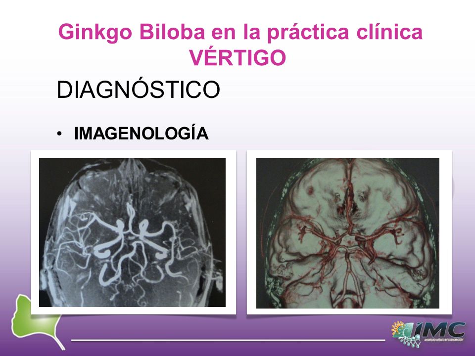 Ginkgo Biloba en la práctica clínica VÉRTIGO