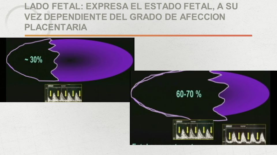 LADO FETAL: EXPRESA EL ESTADO FETAL, A SU VEZ DEPENDIENTE DEL GRADO DE AFECCION PLACENTARIA