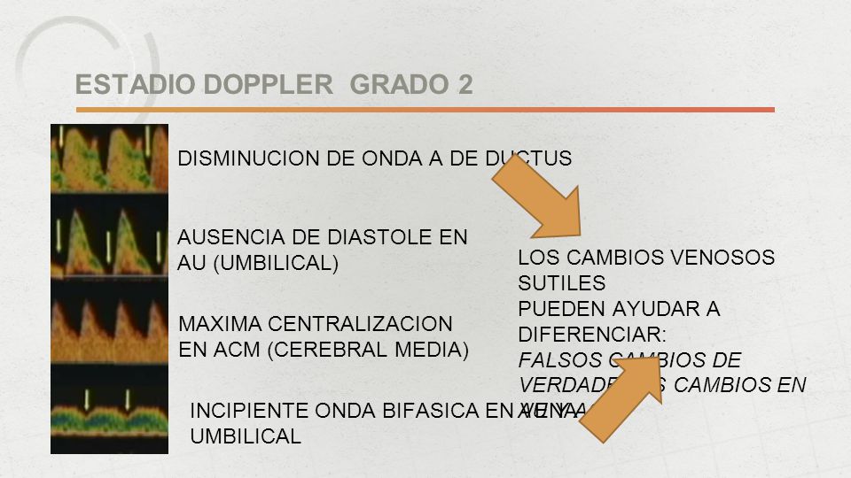 ESTADIO DOPPLER GRADO 2 DISMINUCION DE ONDA A DE DUCTUS