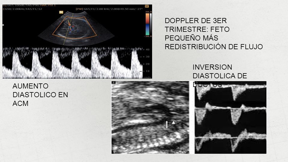 DOPPLER DE 3ER TRIMESTRE: FETO PEQUEÑO MÁS REDISTRIBUCIÓN DE FLUJO