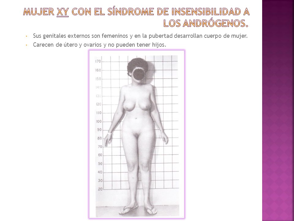 Mujer XY con el síndrome de insensibilidad a los andrógenos.