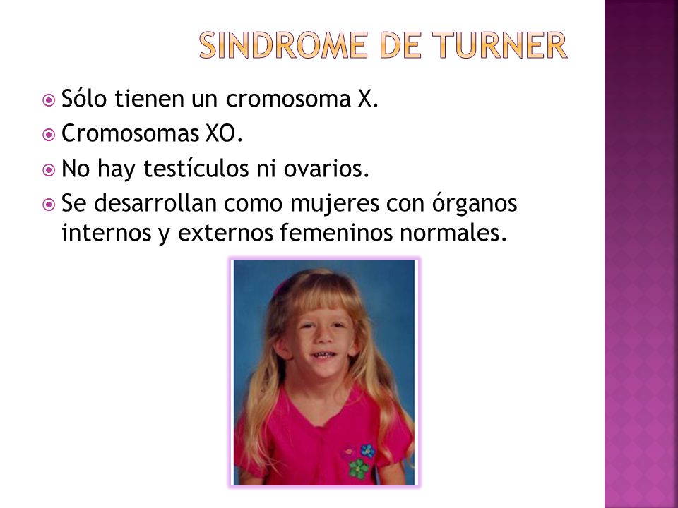 Sindrome de turner Sólo tienen un cromosoma X. Cromosomas XO.