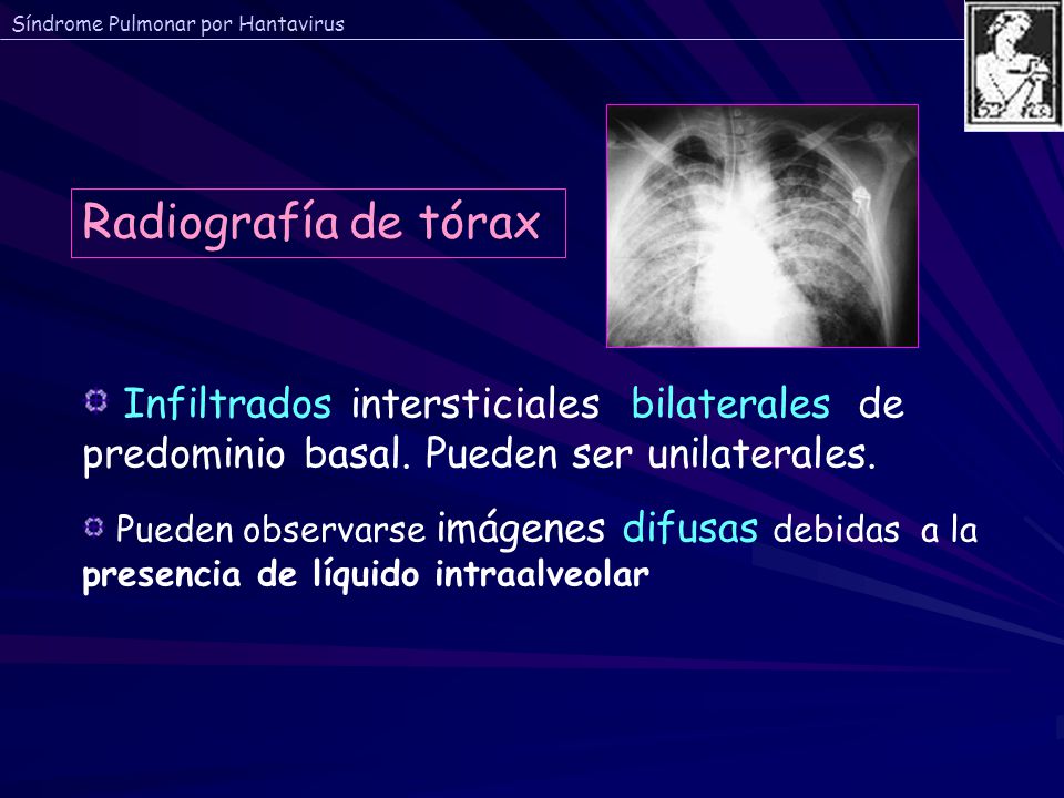 Radiografía de tórax Infiltrados intersticiales bilaterales de predominio basal. Pueden ser unilaterales.