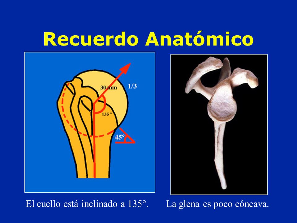 Recuerdo Anatómico El cuello está inclinado a 135°. La glena es poco cóncava.