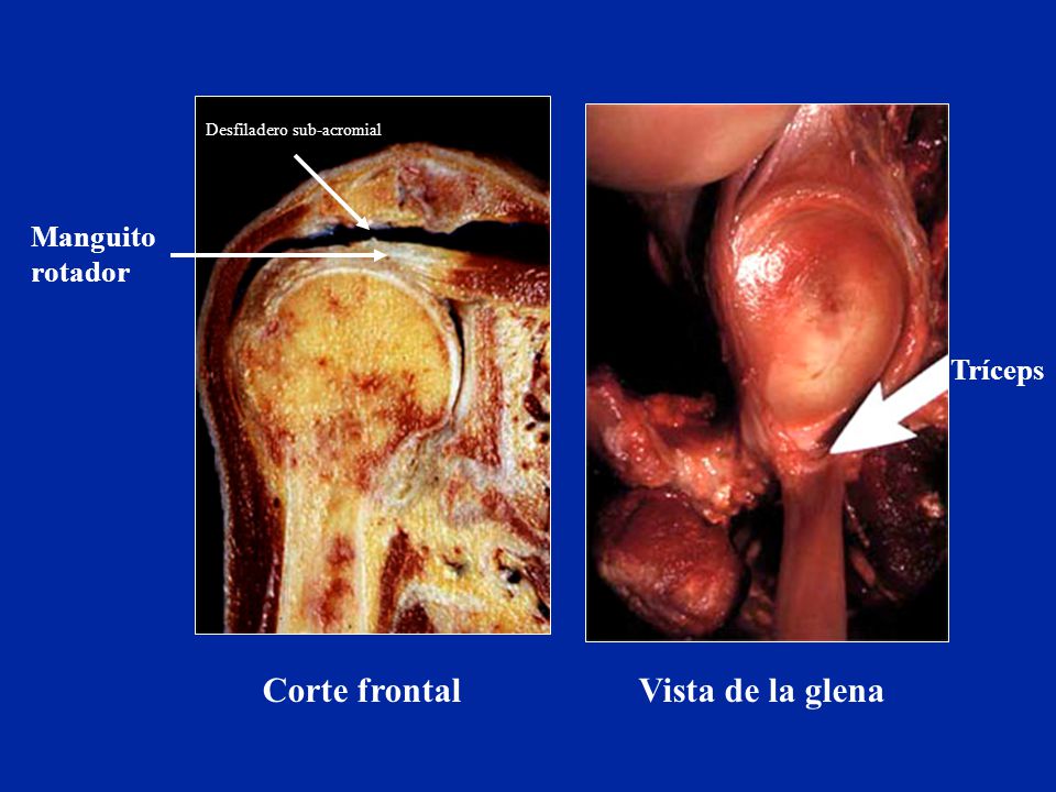 Corte frontal Vista de la glena Manguito rotador Tríceps