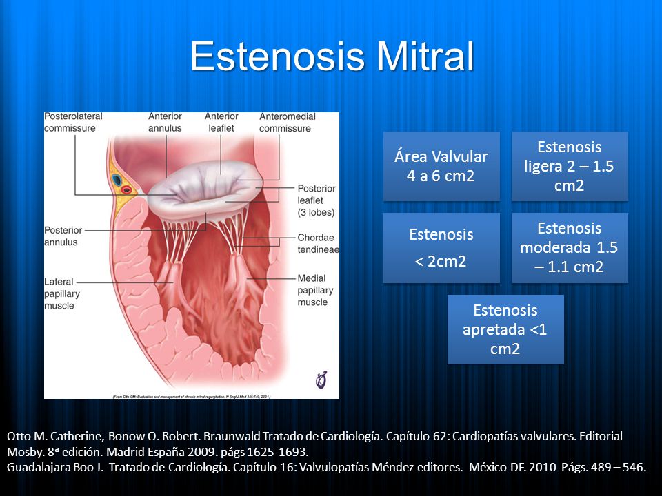 Estenosis Mitral Estenosis ligera 2 – 1.5 cm2 Área Valvular 4 a 6 cm2