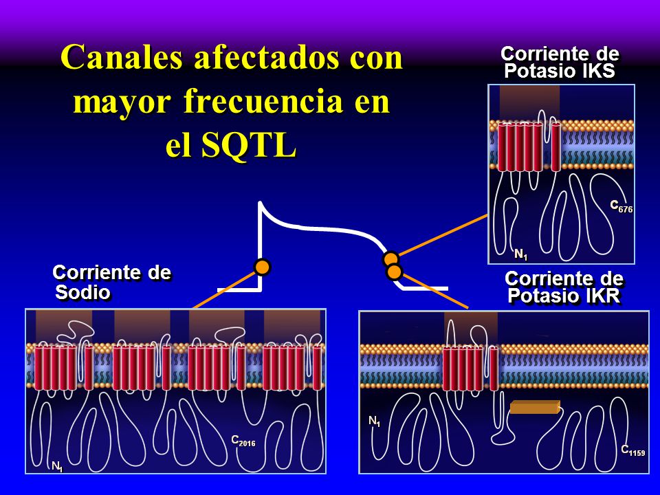 Fenotipo de SQTL3 Segmento ST largo. Onda Bloqueo AV 2:1 asociado