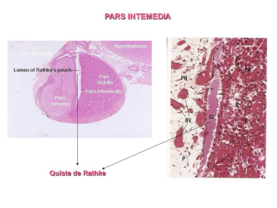 PARS INTEMEDIA Quiste de Rathke