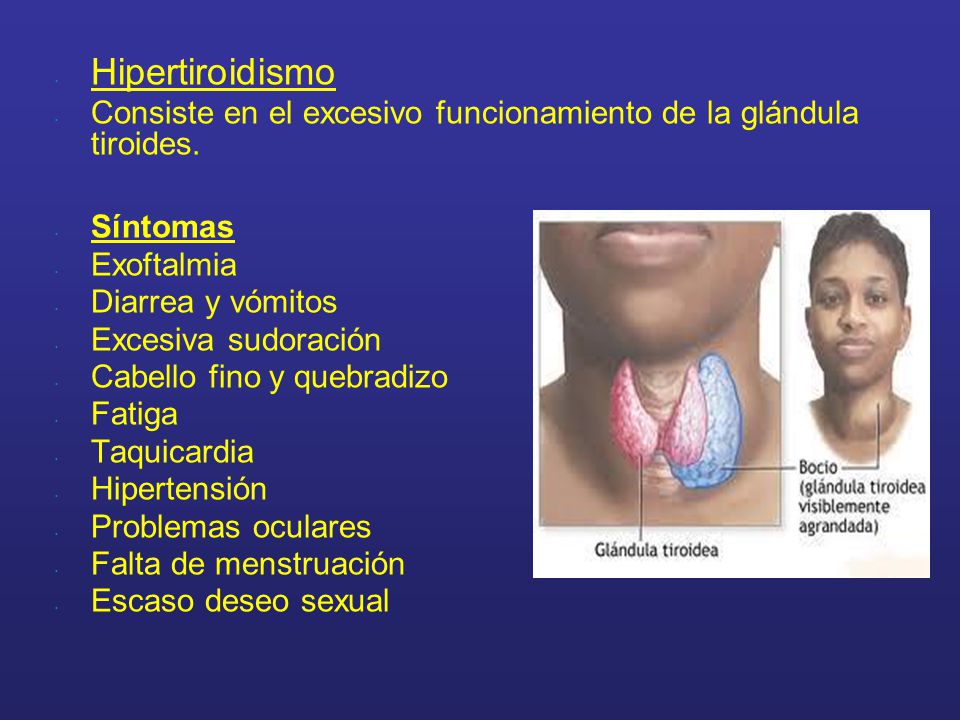 Hipertiroidismo Consiste en el excesivo funcionamiento de la glándula tiroides. Síntomas. Exoftalmia.