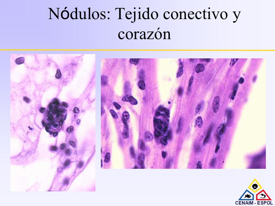 Nódulos: Tejido conectivo y corazón
