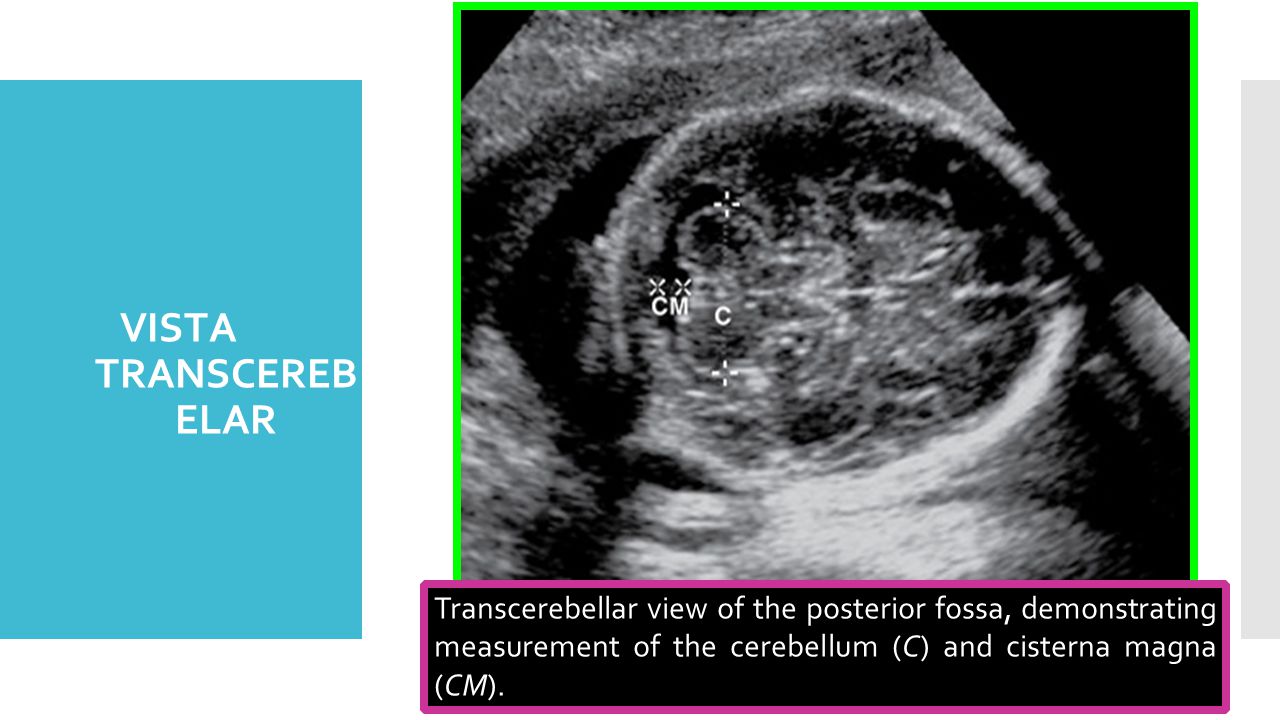 VISTA TRANSCEREBELAR Transcerebellar view of the posterior fossa, demonstrating measurement of the cerebellum (C) and cisterna magna (CM).