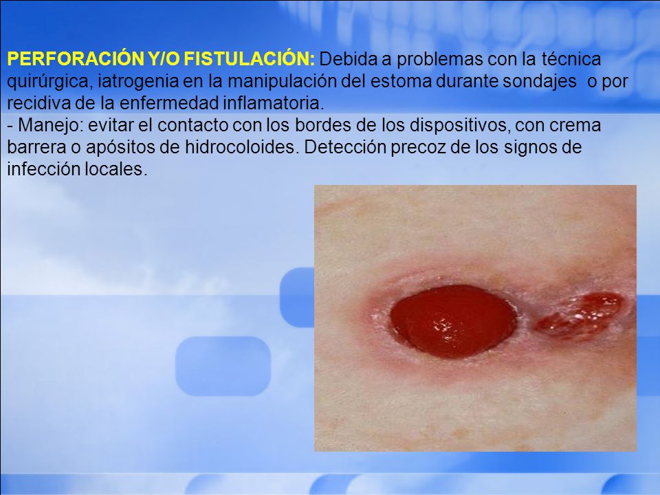 PERFORACIÓN Y/O FISTULACIÓN: Debida a problemas con la técnica quirúrgica, iatrogenia en la manipulación del estoma durante sondajes o por recidiva de la enfermedad inflamatoria.