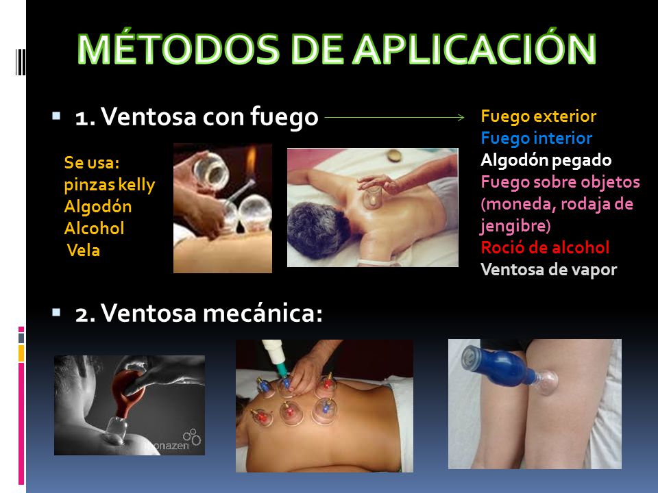 MÉTODOS DE APLICACIÓN 1. Ventosa con fuego 2. Ventosa mecánica: