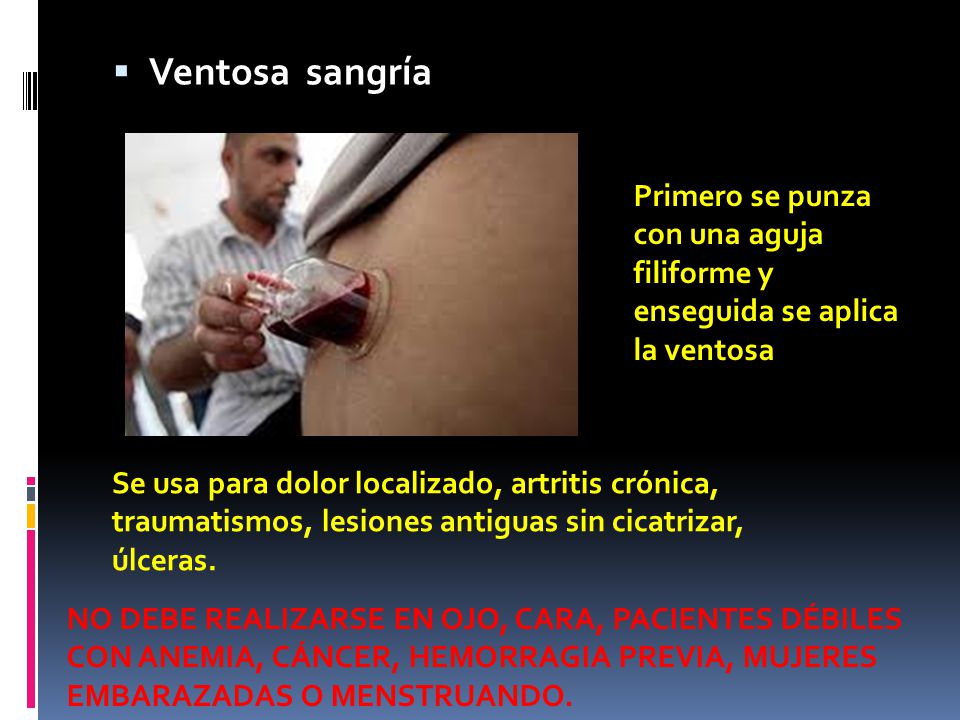 Ventosa sangría Primero se punza con una aguja filiforme y enseguida se aplica la ventosa.