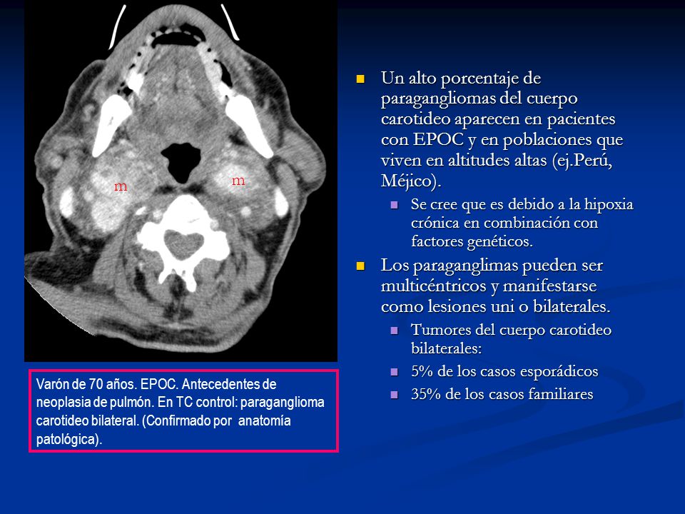 Un alto porcentaje de paragangliomas del cuerpo carotideo aparecen en pacientes con EPOC y en poblaciones que viven en altitudes altas (ej.Perú, Méjico).