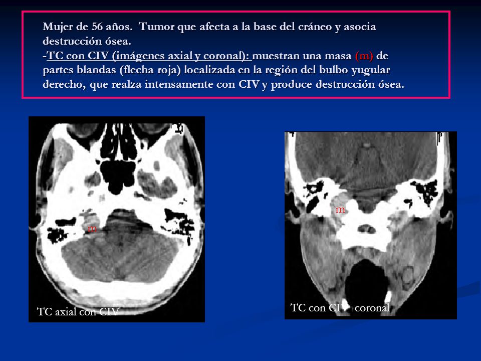 Mujer de 56 años. Tumor que afecta a la base del cráneo y asocia destrucción ósea. -TC con CIV (imágenes axial y coronal): muestran una masa (m) de partes blandas (flecha roja) localizada en la región del bulbo yugular derecho, que realza intensamente con CIV y produce destrucción ósea.
