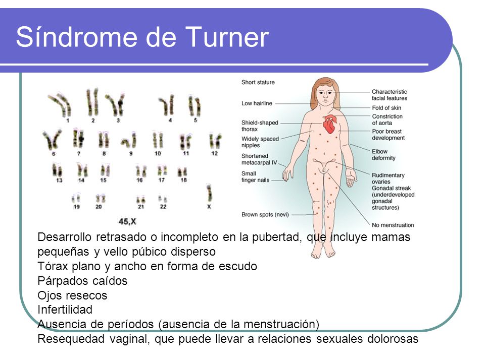 Síndrome de Turner Desarrollo retrasado o incompleto en la pubertad, que incluye mamas pequeñas y vello púbico disperso.