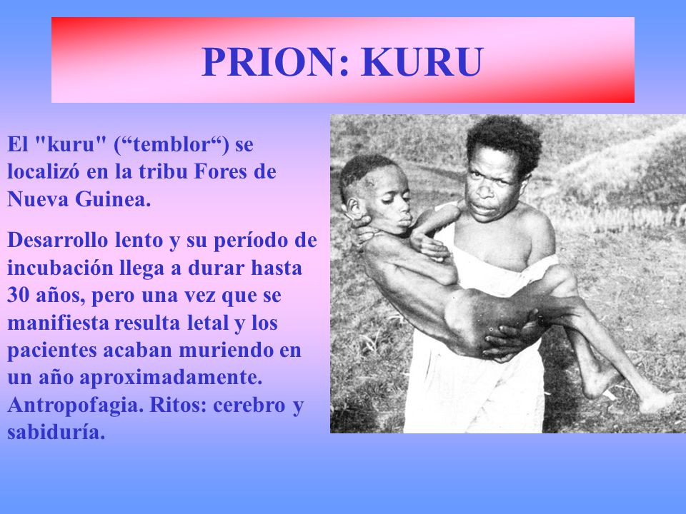 PRION: KURU El kuru ( temblor ) se localizó en la tribu Fores de Nueva Guinea.