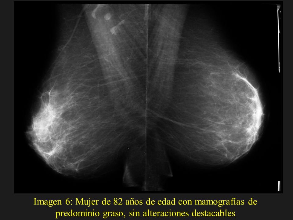 Imagen 6: Mujer de 82 años de edad con mamografías de predominio graso, sin alteraciones destacables