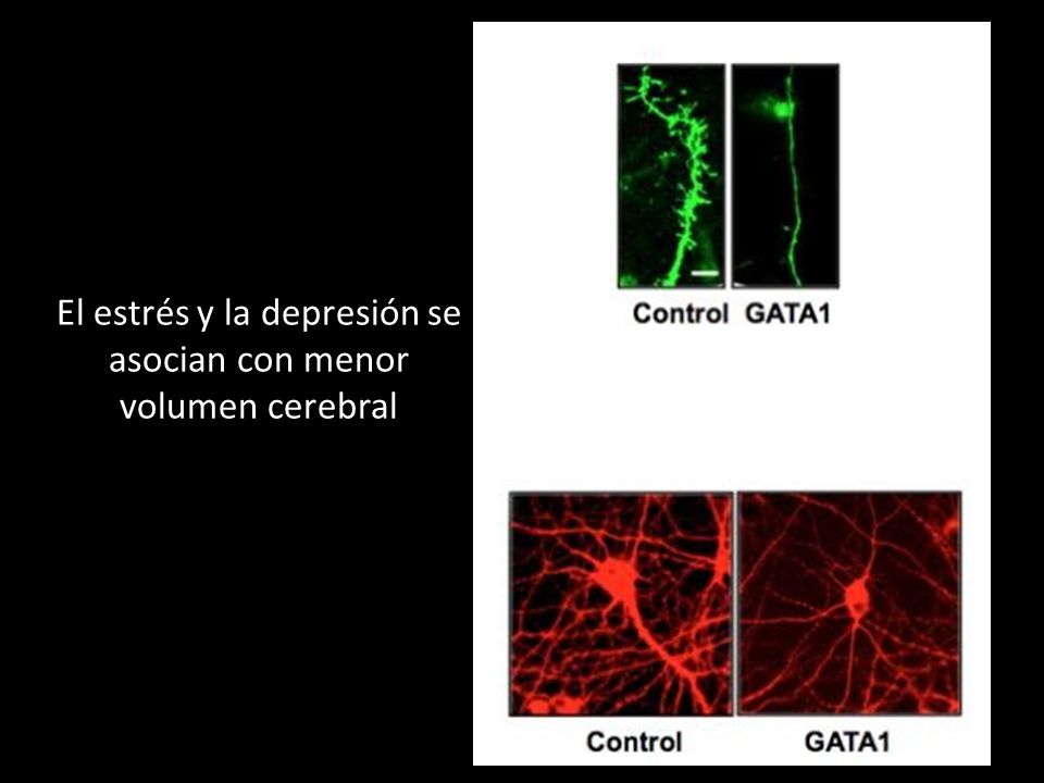 El estrés y la depresión se asocian con menor volumen cerebral