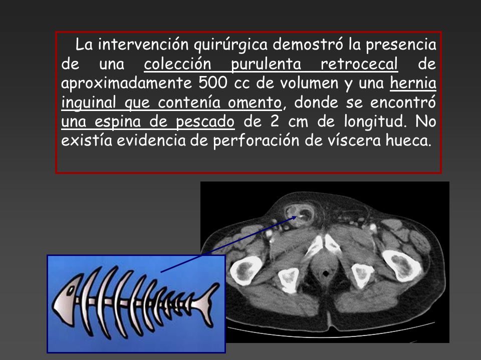 La intervención quirúrgica demostró la presencia de una colección purulenta retrocecal de aproximadamente 500 cc de volumen y una hernia inguinal que contenía omento, donde se encontró una espina de pescado de 2 cm de longitud.