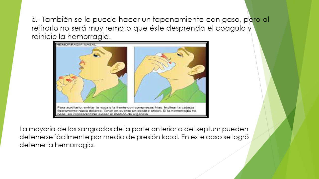 5.- También se le puede hacer un taponamiento con gasa, pero al retirarlo no será muy remoto que éste desprenda el coagulo y reinicie la hemorragia.