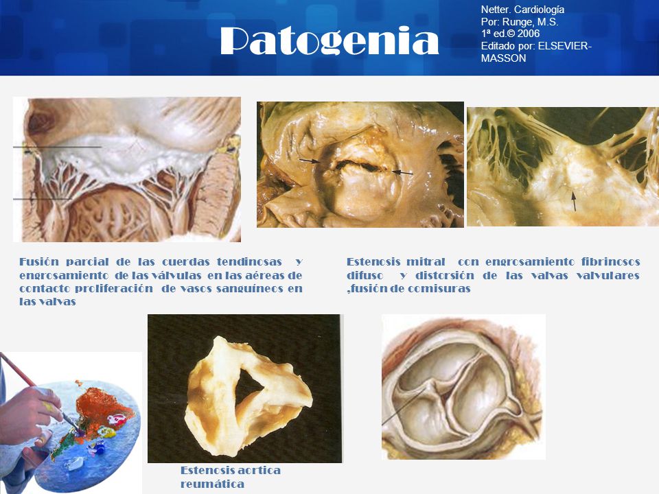 Patogenia Netter. Cardiología. Por: Runge, M.S. 1ª ed.© Editado por: ELSEVIER-MASSON.