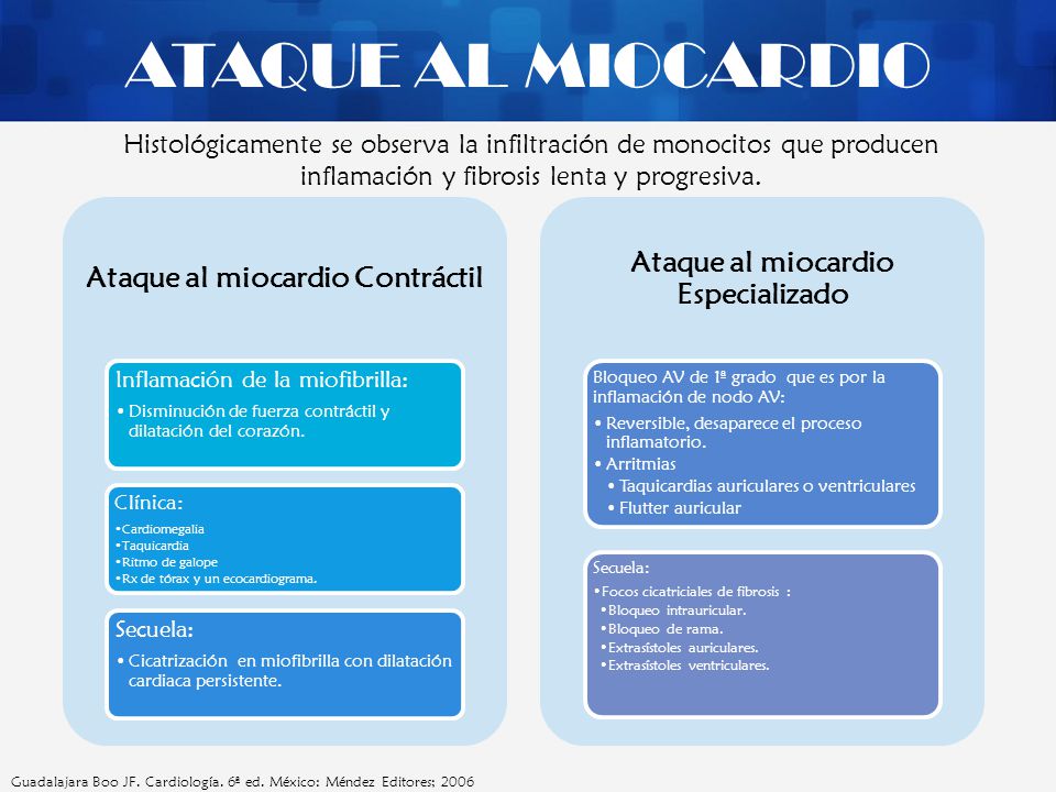 Ataque al miocardio Contráctil Ataque al miocardio Especializado