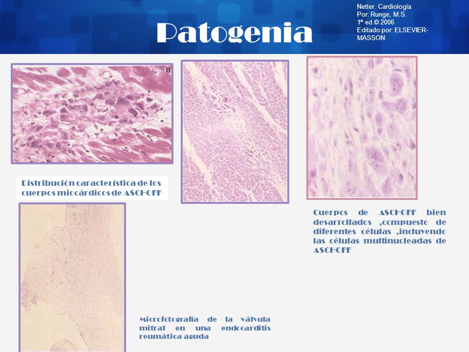 Patogenia Netter. Cardiología. Por: Runge, M.S. 1ª ed.© Editado por: ELSEVIER-MASSON.