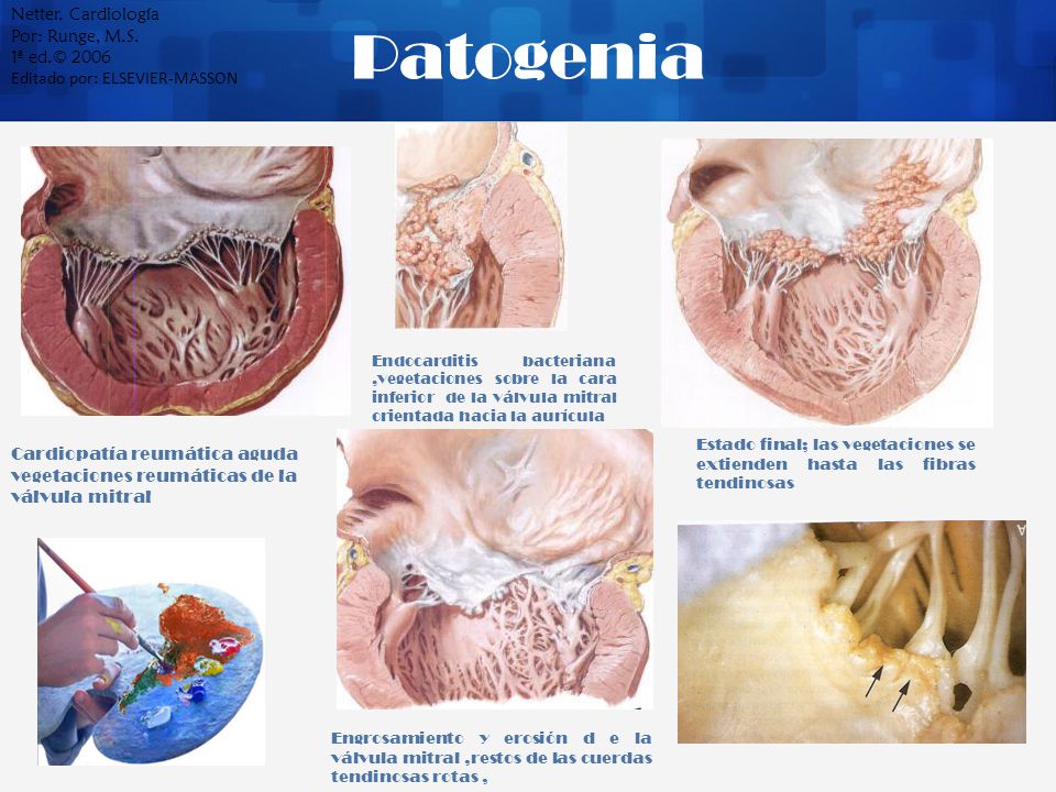Patogenia Netter. Cardiología Por: Runge, M.S. 1ª ed.© 2006