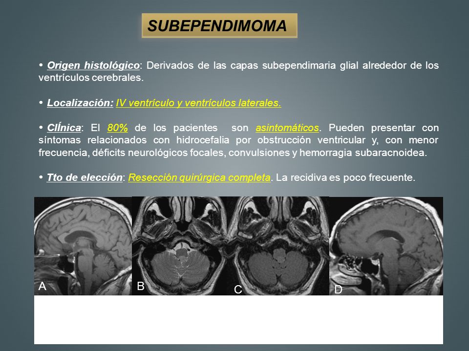SUBEPENDIMOMA Origen histológico: Derivados de las capas subependimaria glial alrededor de los ventrículos cerebrales.