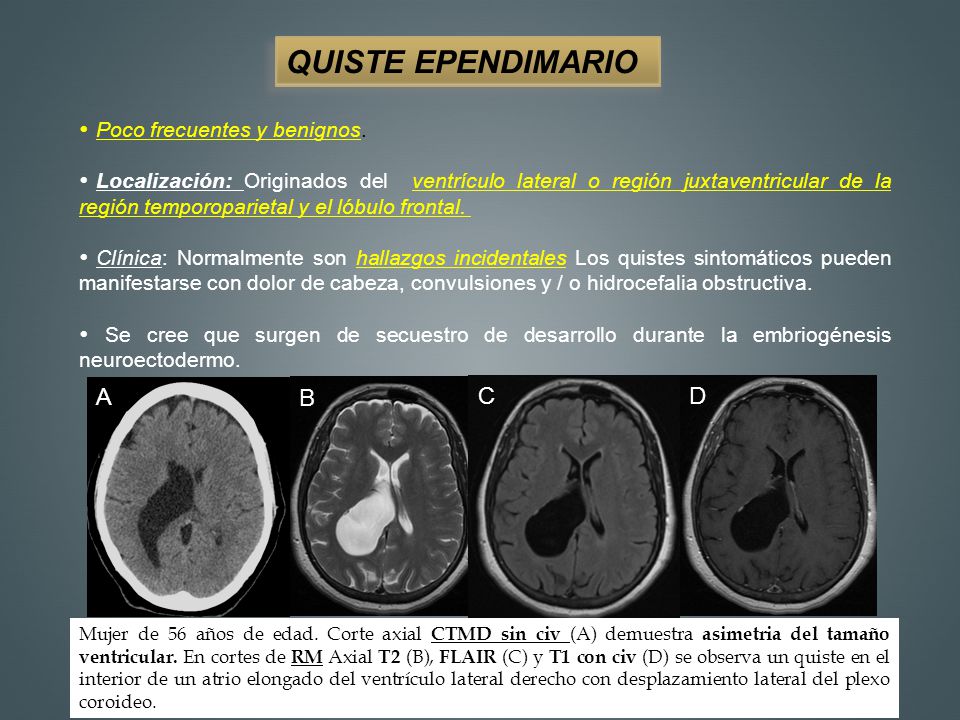 QUISTE EPENDIMARIO A B C D Poco frecuentes y benignos.