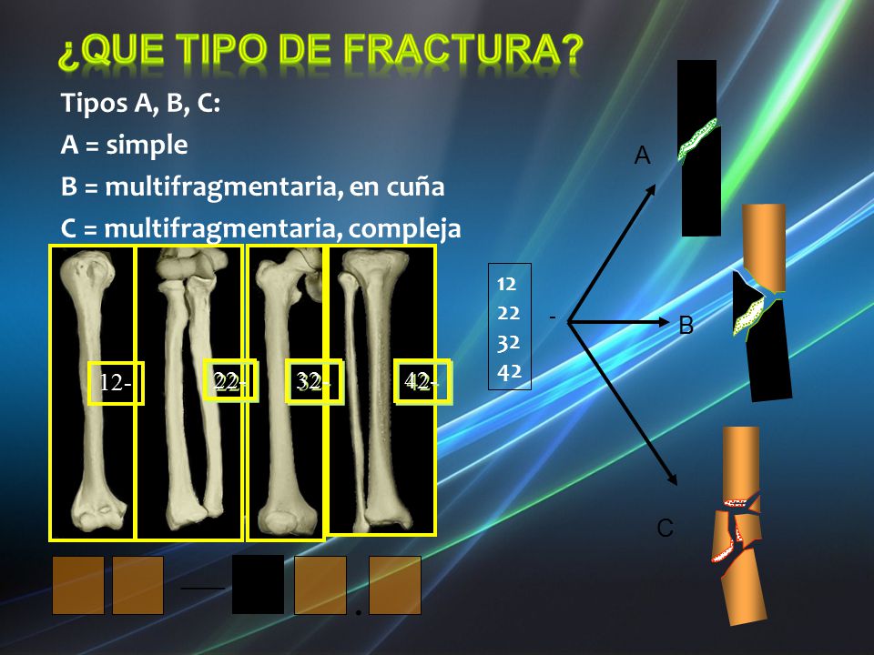 . — ¿Que tipo de fractura Tipos A, B, C: A = simple