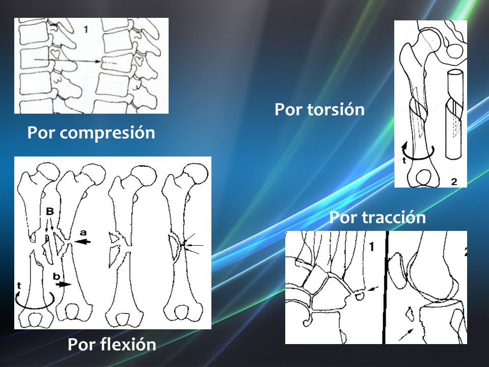 Por torsión Por compresión Por tracción Por flexión