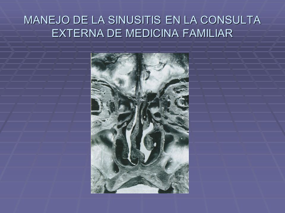MANEJO DE LA SINUSITIS EN LA CONSULTA EXTERNA DE MEDICINA FAMILIAR