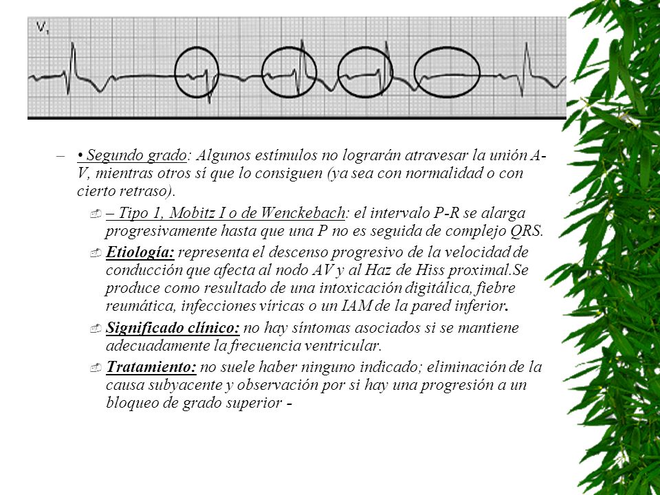 • Segundo grado: Algunos estímulos no lograrán atravesar la unión A-V, mientras otros sí que lo consiguen (ya sea con normalidad o con cierto retraso).