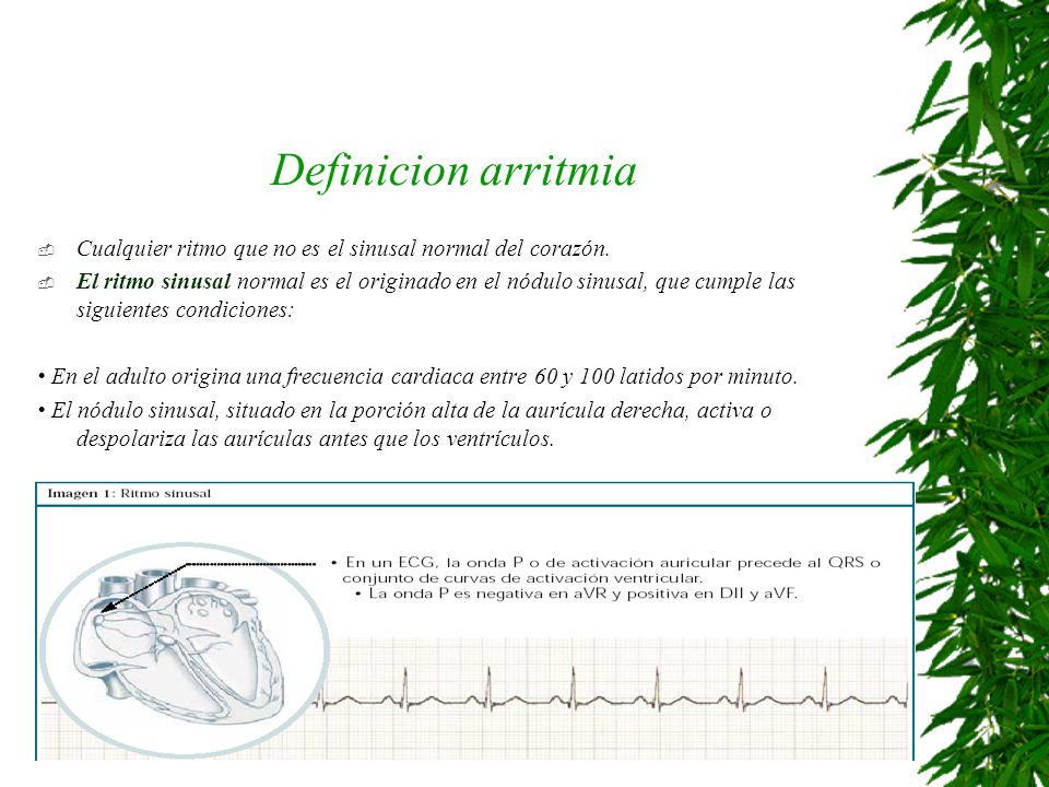 Definicion arritmia Cualquier ritmo que no es el sinusal normal del corazón.