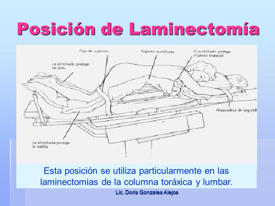 Posición de Laminectomía