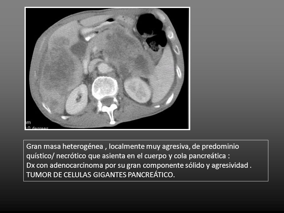 Gran masa heterogénea , localmente muy agresiva, de predominio quístico/ necrótico que asienta en el cuerpo y cola pancreática :