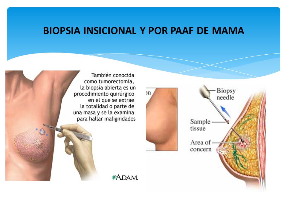 BIOPSIA INSICIONAL Y POR PAAF DE MAMA