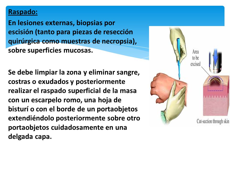 Raspado: En lesiones externas, biopsias por escisión (tanto para piezas de resección quirúrgica como muestras de necropsia), sobre superficies mucosas.