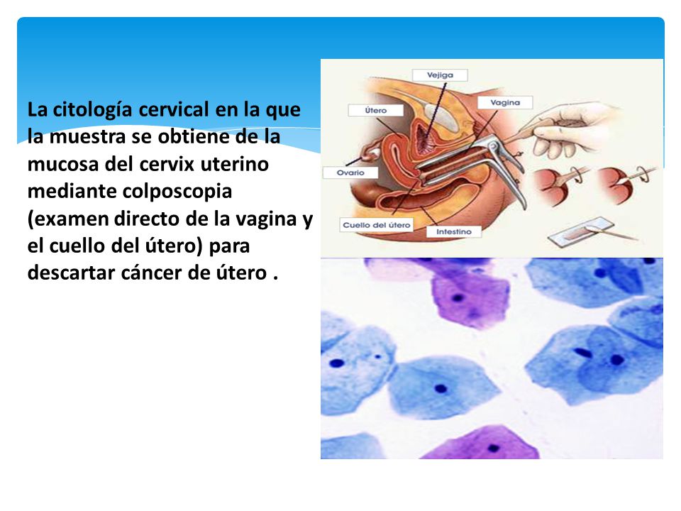 La citología cervical en la que la muestra se obtiene de la mucosa del cervix uterino mediante colposcopia (examen directo de la vagina y el cuello del útero) para descartar cáncer de útero .